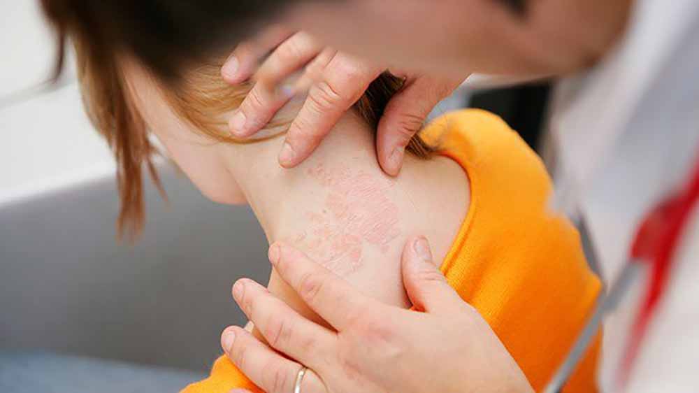 dermatitis-zdravnik